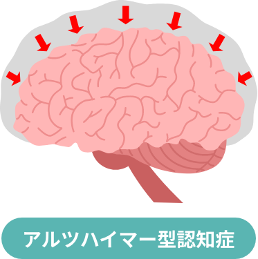アルツハイマー型認知症